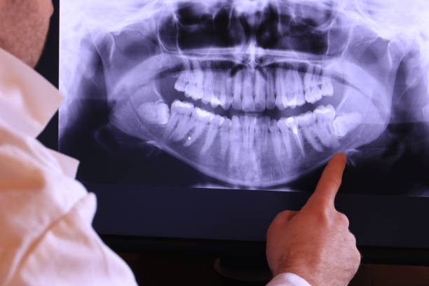 Best Knocked-Out Tooth (Avulsed Tooth) Treatment in Woonsocket, RI